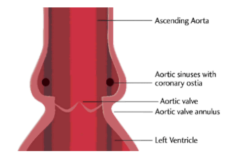 A diagrammatic representation of the location of the aortic valve between the left ventricle and the aorta is shown below